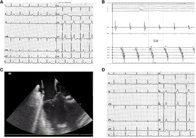 Feasibility and safety of cavotricuspid isthmus ablation using exclusive intracardiac echocardiography guidance: a proof-of-concept, observational trial